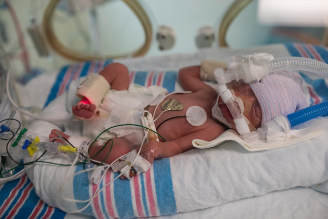 A premature baby resting in a NICU incubator with breathing support and monitoring leads.